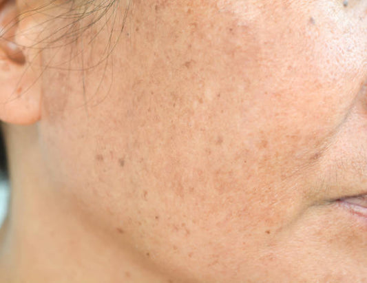 Can Skin Damage Caused by the Sun Be Reversed?